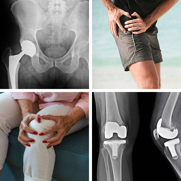 Knee and Hip Joint Replacement