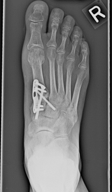 X-Rayed Foot fixed