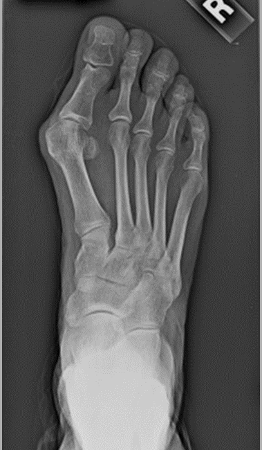 X-Rayed Foot